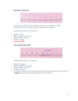 Asystole - Abnormal
A state of no cardiac electrical activity, as such no contractions of the 
myocardium and no cardiac outp