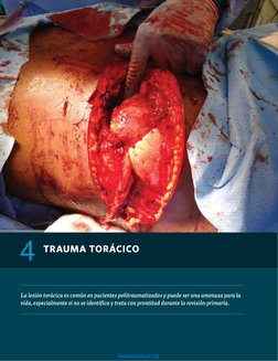 ­62	
CAPÍTULO 4 n Trauma Torácico
TRAUMA TORÁCICO 
4
La lesión torácica es común en pacientes politraumatizados y puede ser u