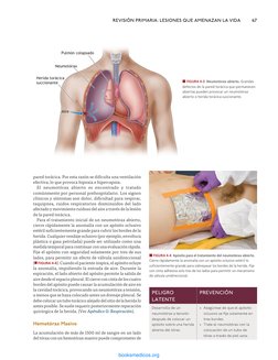 pared torácica. Por esta razón se dificulta una ventilación 
efectiva, lo que provoca hipoxia e hipercapnia.
El neumotórax ab