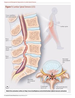 6 Journal of Current Clinical Care January/February 2011
 Diagnosis and Management Approaches to Lumbar Spinal Stenosis
Herni