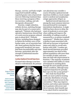 Figure 4
 Image of a Lumbar 
Epidural Steroid 
Injection
 Anterior to posterior 
f uoroscopic image of 
right L5 transforami
