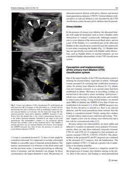 UTD Classification Update for Urinary Dilation | PDF | Kidney | Urology