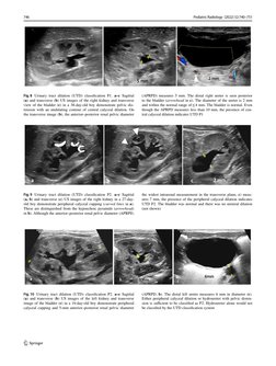 UTD Classification Update for Urinary Dilation | PDF | Kidney | Urology