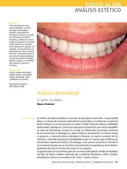 [Resumen]
Todos deseamos lucir una 
sonrisa agradable. La tarea 
del equipo odontológico-
protésico responsable del 
tratamie