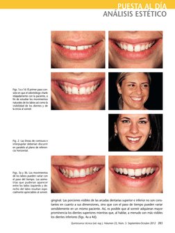 Quintessence técnica (ed. esp.). Volumen 23, Núm. 5. Septiembre-Octubre 2012  283
PUESTA AL DÍA
ANÁLISIS ESTÉTICO
gingival. L