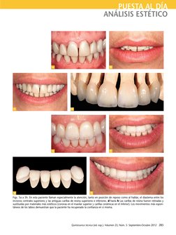Quintessence técnica (ed. esp.). Volumen 23, Núm. 5. Septiembre-Octubre 2012  285
PUESTA AL DÍA
ANÁLISIS ESTÉTICO
Figs. 5a a