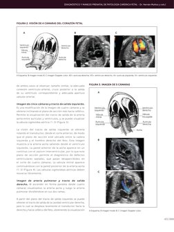 451
VD
VI
AD
AI
Ventrículo
izquierdo
Aurícula
izquierda
Aurícula
derecha
Ventrículo
derecho
Válvula
mitral
FIGURA 2. VISIÓN D