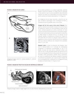 452
FIGURA 5. IMAGEN DE TRACTO DE SALIDA DE VENTRÍCULO DERECHO
A
B
C
Arteria pulmonar izquierda
Válvula pulmonar
Válvula tric