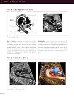 454
Arco aórtico. No corresponde a un plano ecotomográfico 
clásico. Se obtiene realizando un plano de sección 
longitudinal