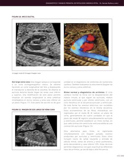 455
FIGURA 11. IMAGEN DE EJE LARGO DE VENA CAVA
A imagen modo B, B imagen Doppler color. 
FIGURA 10. ARCO DUCTAL
A
B
[DIAGNÓS