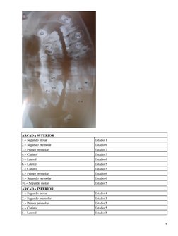 ARCADA SUPERIOR
1.− Segundo molar
Estadio 1
2.− Segundo premolar
Estadio 6
3.− Primer premolar
Estadio 7
4.− Canino
Estadio 5