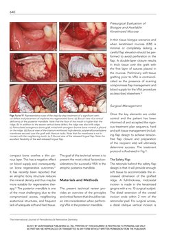 Principles For Vertical Ridge Augmentation 2017 | PDF | Dental Implant ...