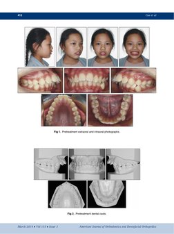 AJODO-mechanism-case Report | PDF | Orthodontics | Dental Anatomy