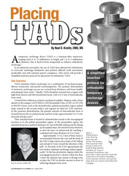 Tad Example TAD Insertion Protocol for Orthodontics | PDF | Orthodontics | Surgery