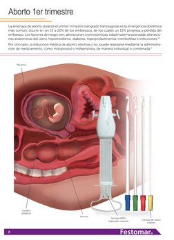 8
Aborto 1er trimestre
La amenaza de aborto durante el primer trimestre (sangrado transvaginal) es la emergencia obstétrica