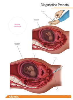 3
Diagnóstico Prenatal
Biopsia
coriónica
Jeringa
Vellosidades
coriónicas
Vellosidades 
coriónicas
Cérvix
Vagina
Catéter
