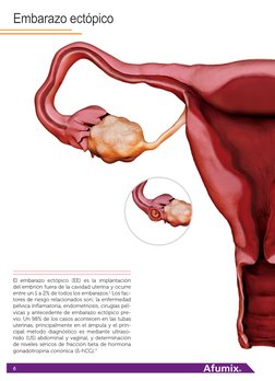 6
Embarazo ectópico
El embarazo ectópico (EE) es la implantación 
del embrión fuera de la cavidad uterina y ocurre 
entre un