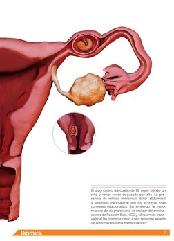 7
El diagnóstico adecuado de EE sigue siendo un 
reto y varias veces es pasado por alto. La pre-
sencia de retraso menstrual,