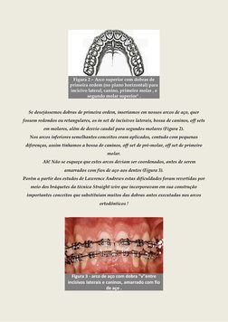 Figura 2 – Arco superior com dobras de 
primeira ordem (no plano horizontal) para 
incicivo lateral, canino, primeiro m