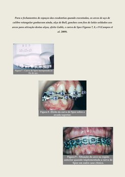 Para o fechamentos de espaços das exodontias quando executadas, os arcos de aço de 
calibre retangular ganhavam ainda,