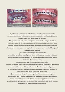 Figura 13 – Fio de nitinol calibre .014” 
inserido na arcada inferior.
    
Figura 14 – Fio de nitinol calibre .016”