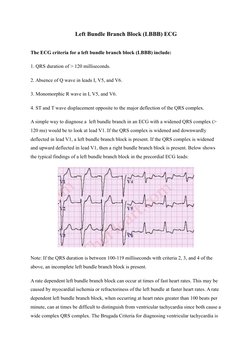 Left Bundle Branch Block (LBBB) ECG
The ECG criteria for a left bundle branch block (LBBB) include:
1. QRS duration of > 120