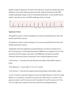 helpful to make this distinction. The below ECG strip shows normal sinus rhythm, then atrial 
fibrillation with a rapid ventr