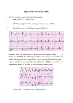 Right Bundle Branch Block ECG
The ECG criteria for a right bundle branch block include:
1.
QRS duration of > 120 milliseconds