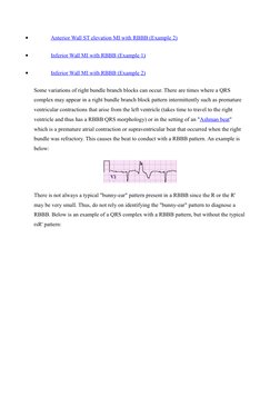 
Anterior Wall ST elevation MI with RBBB (Example 2) (http://www.learntheheart.com/ecg-review/ecg-archive/anterior-st-elevat