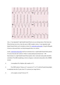 Also, a "rate dependent" right bundle branch block can occur during times of fast heart rate. 
When the heart rate slows, the