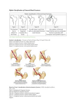 Pipkin Classification of Femoral Head Fractures 
Garden’s classification : Fracture of Neck of Femur (Figs 3.53 and 3.54A to