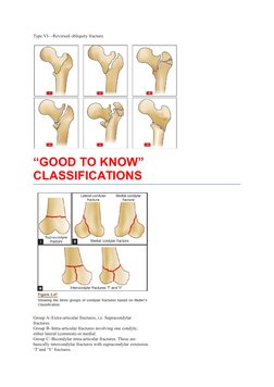 Type VI—Reversed obliquity fracture.
“GOOD TO KNOW” 
CLASSIFICATIONS 
Group A–Extra-articular fractures, i.e. Supracondylar
f
