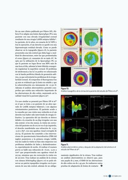 OCTUBRE  2014
  nº 496
En un caso clínico publicado por Piñero DP y Ri-
bera D se adapta una lentes SynergEyes PS a una 
paci