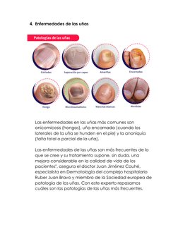 4. Enfermedades de las uñas 
 
 
Las enfermedades en las uñas más comunes son 
onicomicosis (hongos), uña encarnada (cuando l
