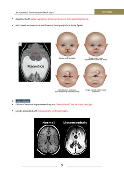 EL Husseiny's Essentials for USMLE step 1 
            Neurology 
 
 
 
5 
 
 
 
▪ 
Associated with patau’s syndrome (trisomy