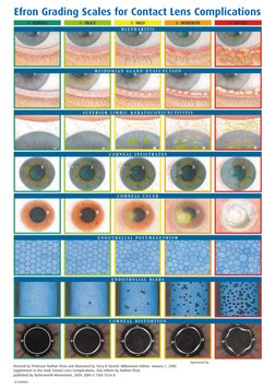 Efron Grading Scales for Contact Lenses | PDF