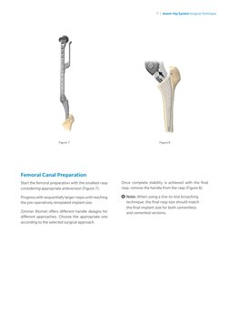 Avenir Hip System Surgical Technique | PDF | Hip | Clinical Medicine