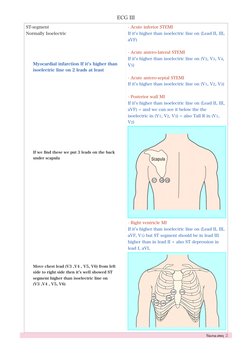 ECG III
Nawraa ateeq  2
ST-segment  
Normally Isoelectric  
- Acute inferior STEMI  
If it’s higher than isoelectric line on