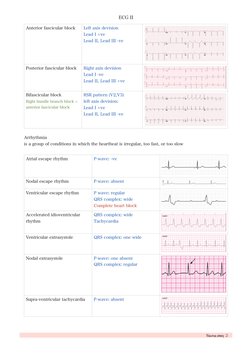 ECG II
Arrhythmia  
is a group of conditions in which the heartbeat is irregular, too fast, or too slow 
Anterior fascicular