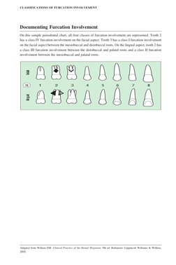 Furcation Involvement Classifications | PDF